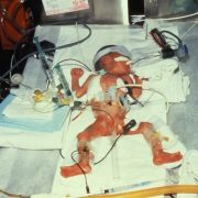 1980 Premature Infant in Intensive Care Minorities and Tobacco